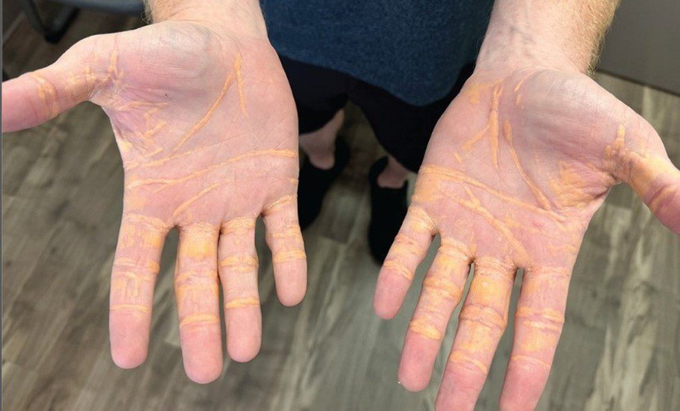 Xantelasma: entenda o quadro que cria nódulos de gordura no corpo por excesso de colesterol
